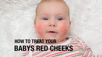 Baby Acne and Cradle Cap Videos