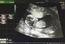 Miscarriage ultrasound