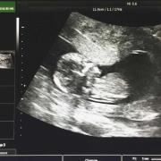 Miscarriage ultrasound